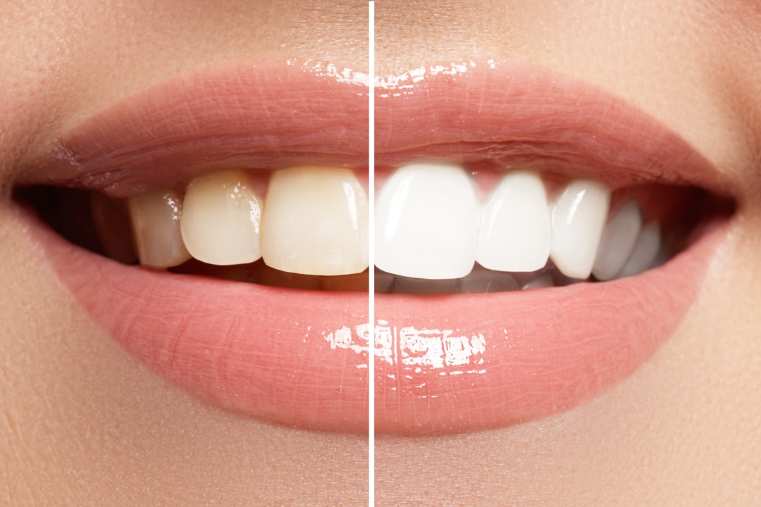 Teeth Whitening Adelaide